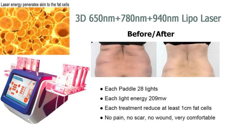 Why Choose Lipo Laser Machine For Body Slimming